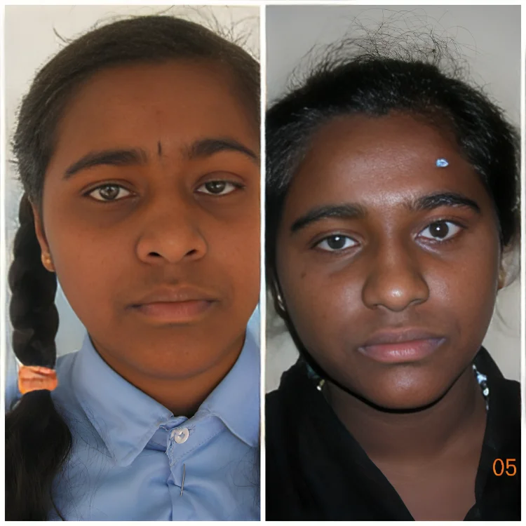 Oculoplasty-8